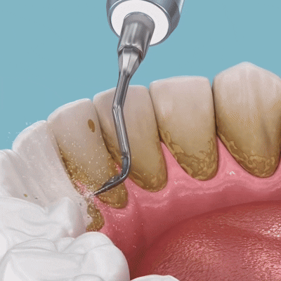 Dentist-Smooth Feeling in Minutes